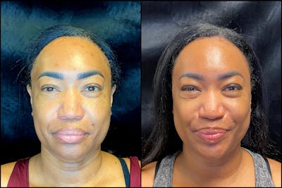 Chemical Peels Before & After Gallery - Patient 63181892 - Image 1