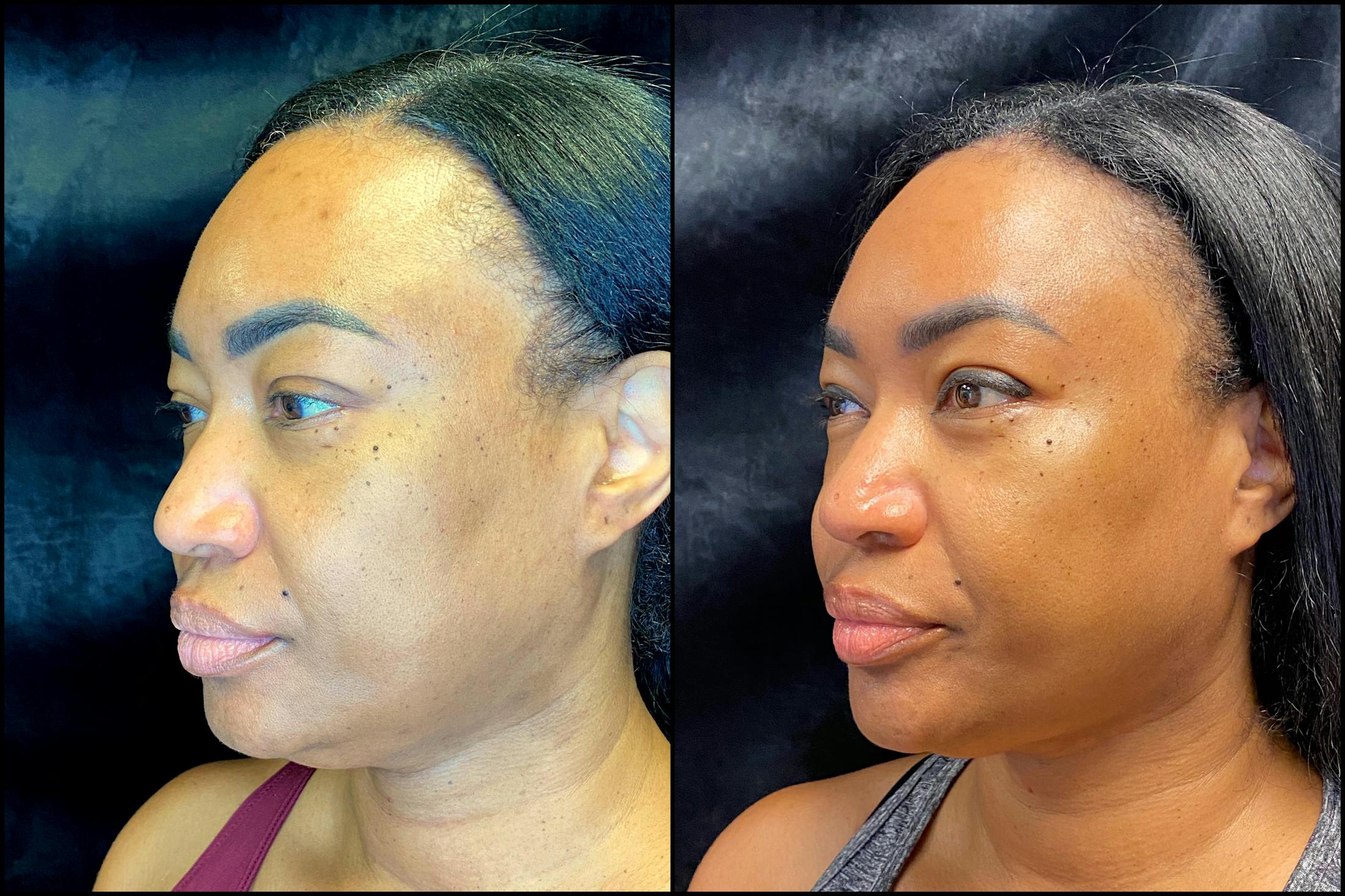 Chemical Peels Before & After Gallery - Patient 63181892 - Image 2