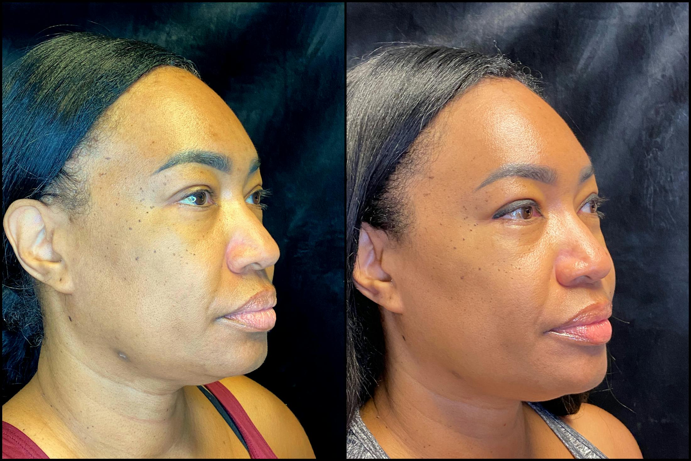 Chemical Peels Gallery - Patient 63181892 - Image 3