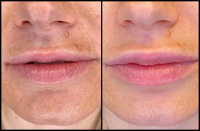Dermal Fillers Before & After Gallery - Patient 79766315 - Image 1