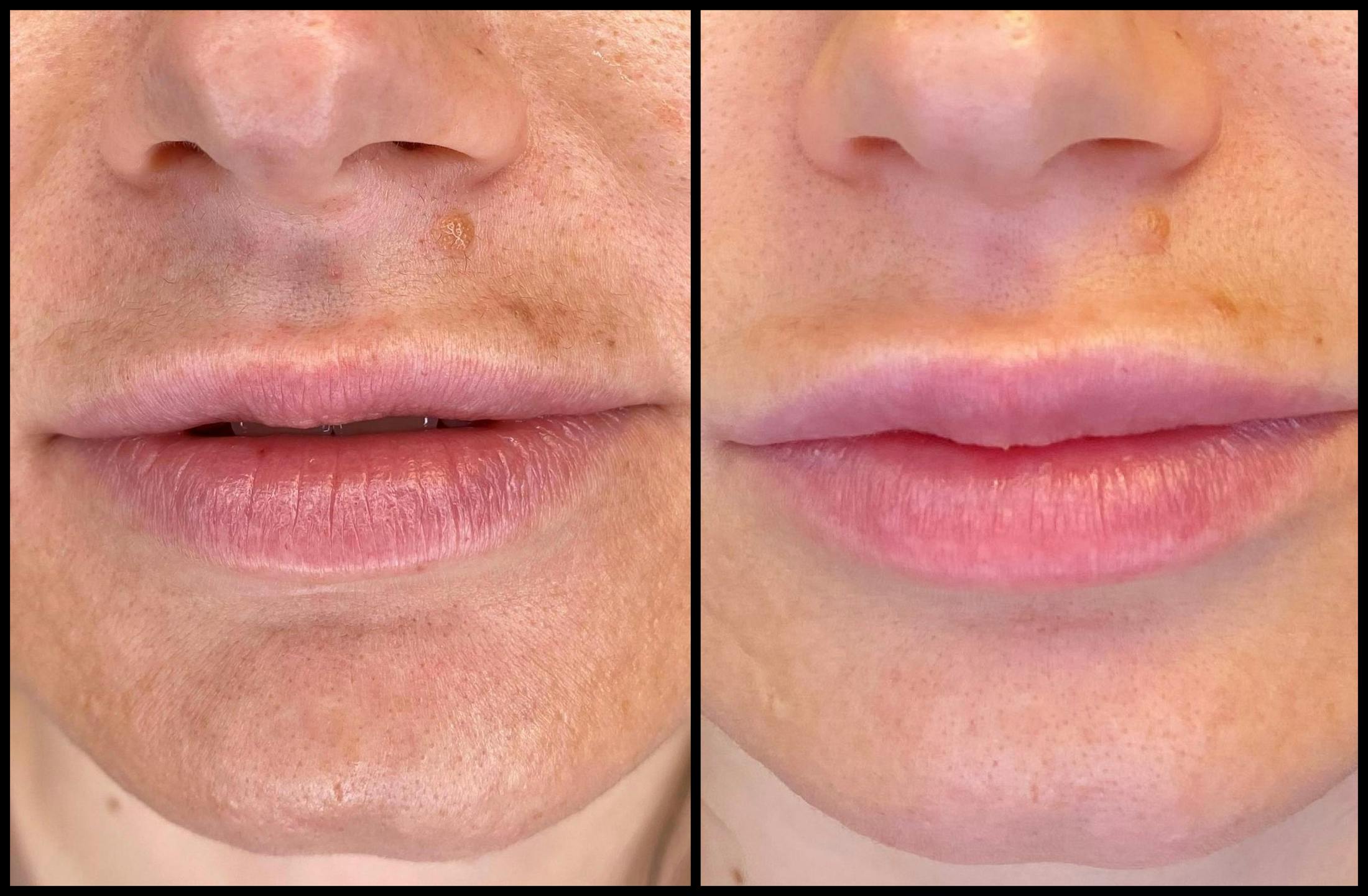 Dermal Fillers Before & After Gallery - Patient 79766315 - Image 1