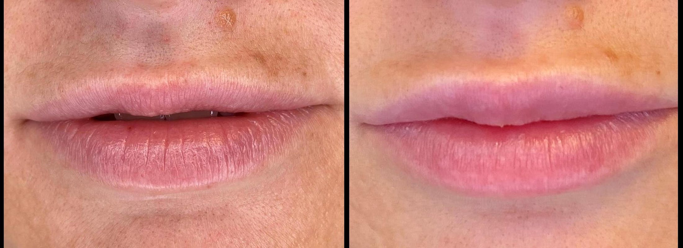 Dermal Fillers Before & After Gallery - Patient 79766315 - Image 2