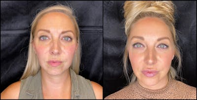 Dermal Fillers Before & After Gallery - Patient 79766306 - Image 1