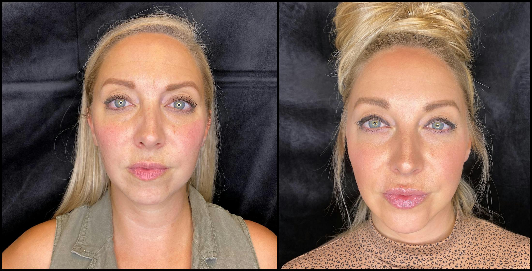 Dermal Fillers Before & After Gallery - Patient 79766306 - Image 1