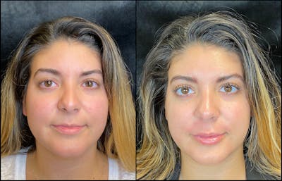 Dermal Fillers Before & After Gallery - Patient 79766290 - Image 1