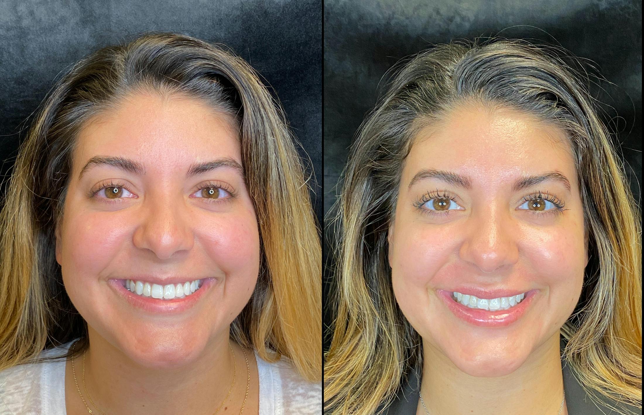 Dermal Fillers Before & After Gallery - Patient 79766290 - Image 2