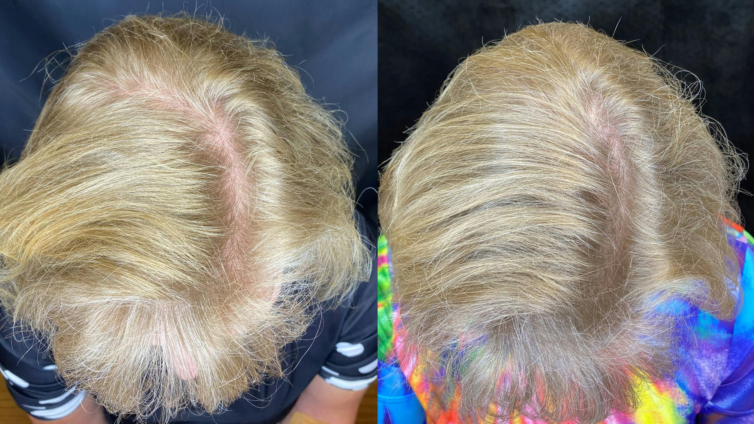 PRP Hair Restoration