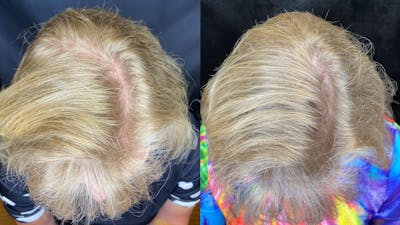 PRP Hair Restoration Before & After Gallery - Patient 154143467 - Image 1
