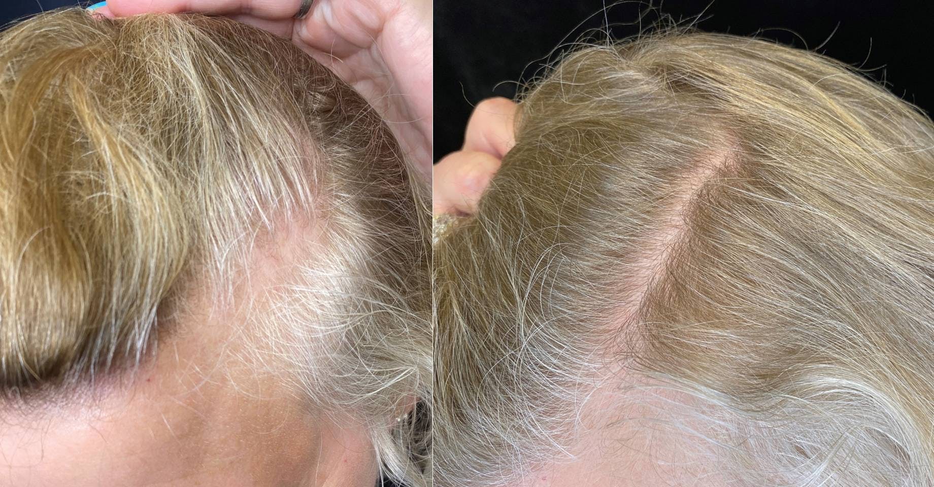 PRP Hair Restoration Before & After Gallery - Patient 154143467 - Image 2