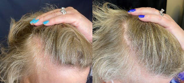 PRP Hair Restoration Before & After Gallery - Patient 154143467 - Image 4