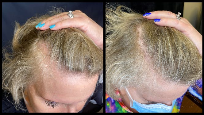PRP Hair Restoration Before & After Gallery - Patient 154143467 - Image 3