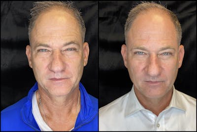 Morpheus8 Before & After Gallery - Patient 63181922 - Image 1