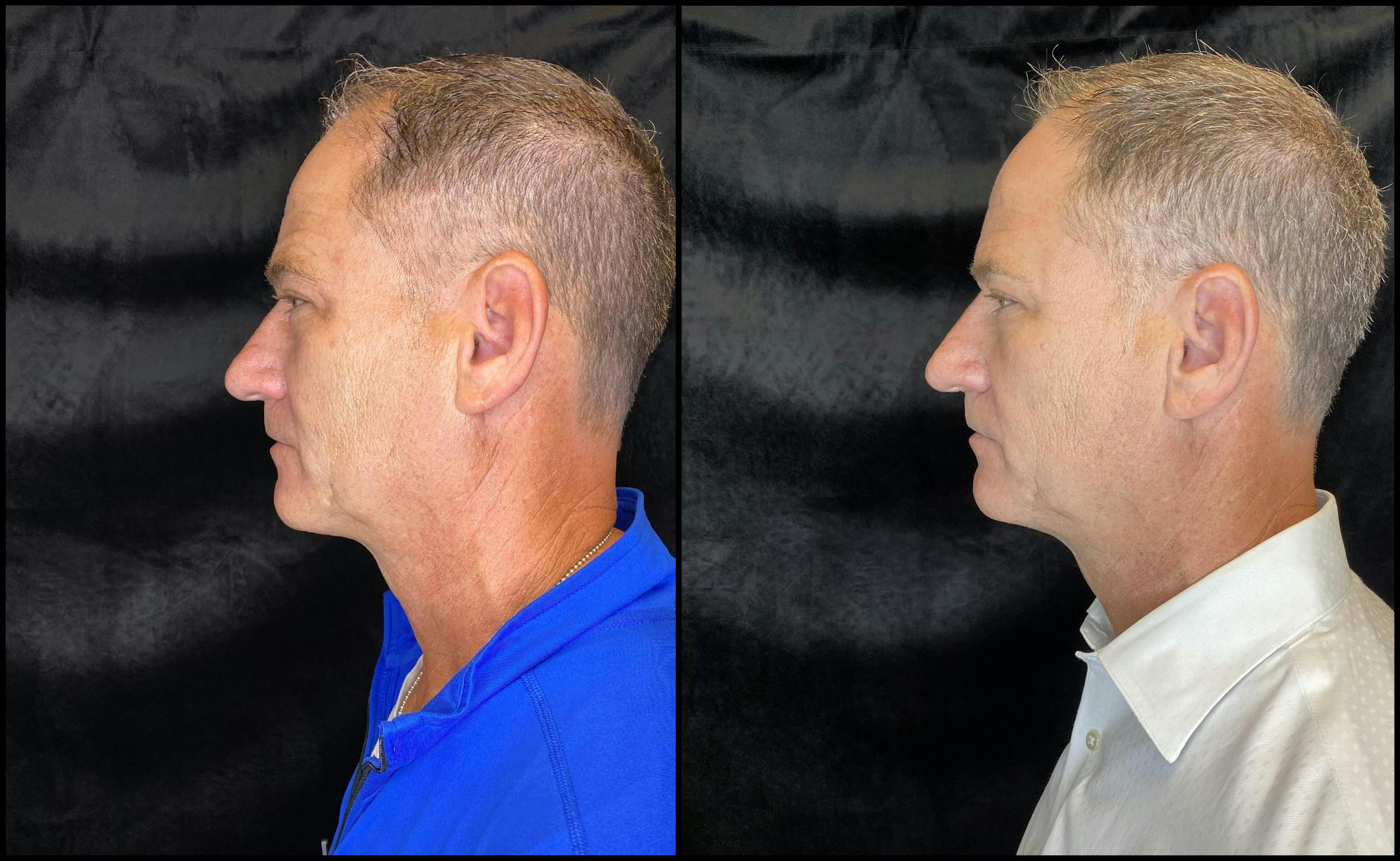 Morpheus8 Before & After Gallery - Patient 63181922 - Image 3