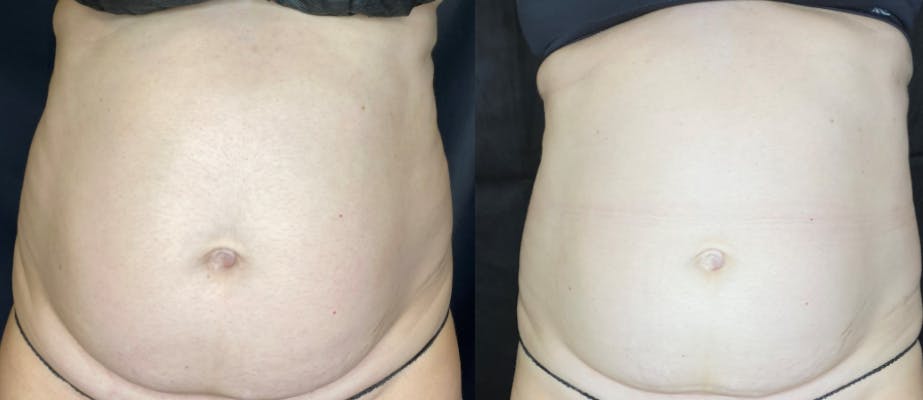 SculpSure results in Austin at Modern Women's Health