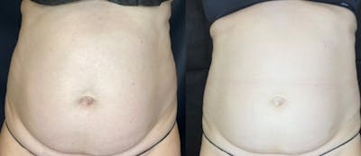 SculpSure Before & After Gallery - Patient 63181923 - Image 1