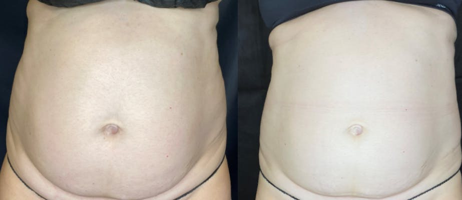 SculpSure Before & After Gallery - Patient 63181923 - Image 1