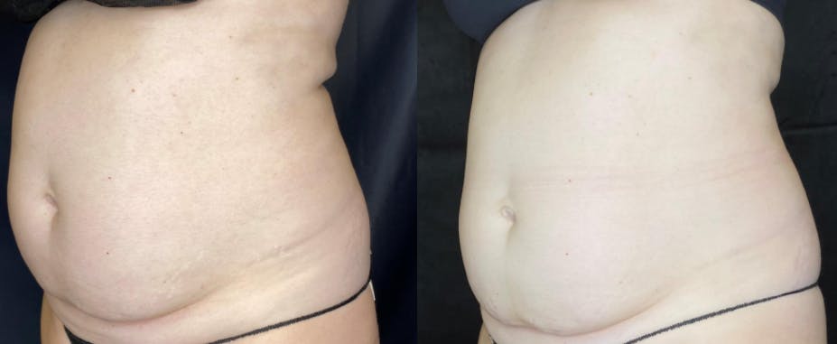 SculpSure Before & After Gallery - Patient 63181923 - Image 2