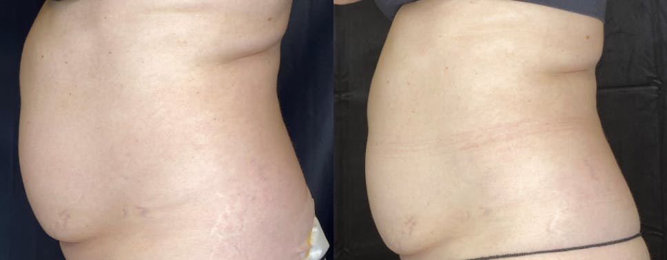 SculpSure Before & After Gallery - Patient 63181923 - Image 3
