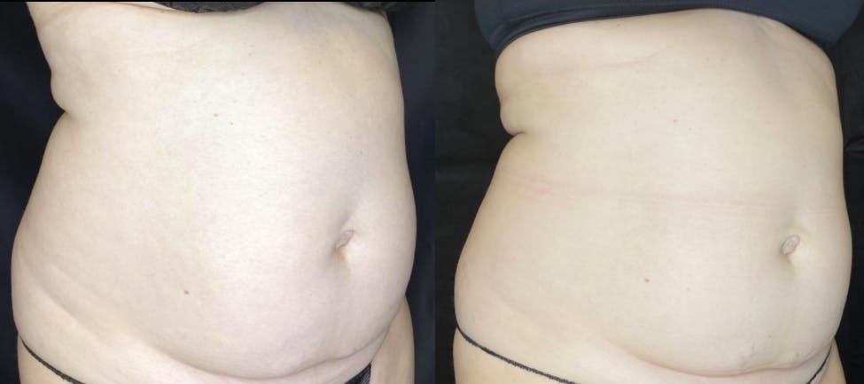 SculpSure Before & After Gallery - Patient 63181923 - Image 4