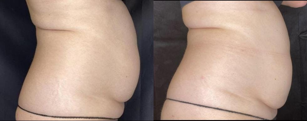 SculpSure Before & After Gallery - Patient 63181923 - Image 5