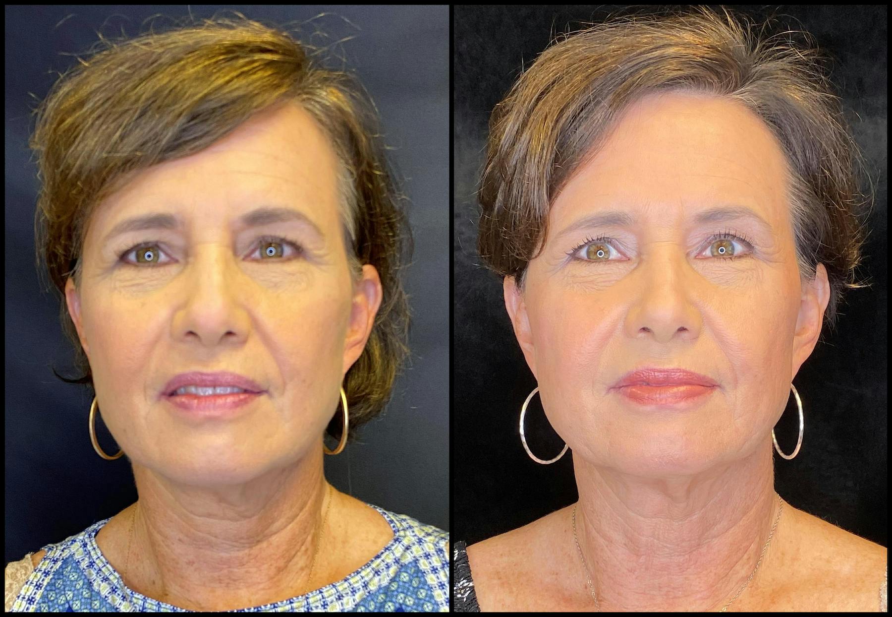 Before and after FaceTite in Austin at Modern Women's Health