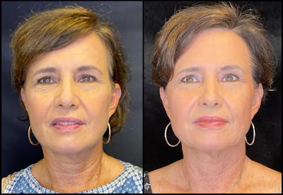 AccuTite & FaceTite Before & After Gallery - Patient 63591875 - Image 1