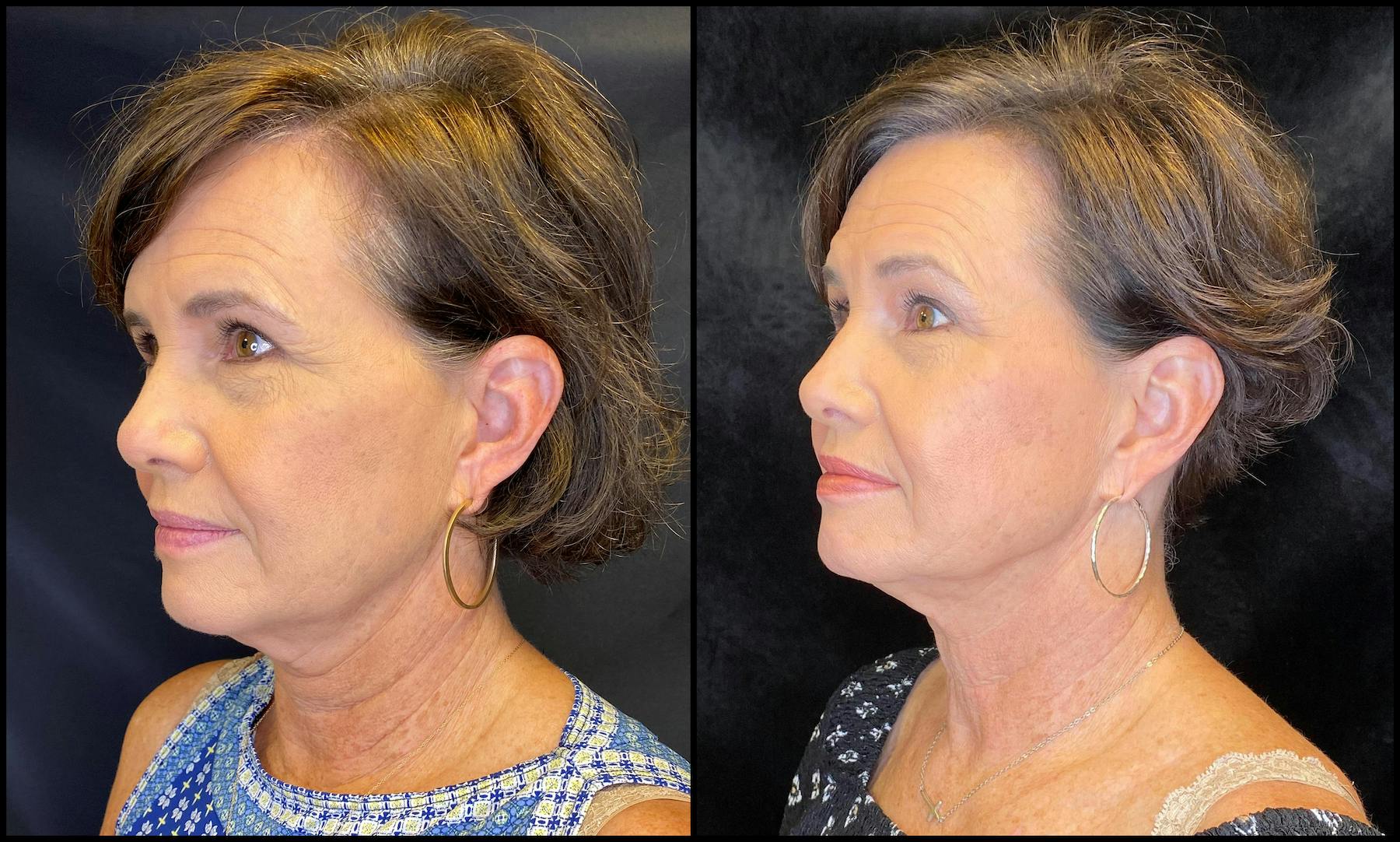 AccuTite & FaceTite Before & After Gallery - Patient 63591875 - Image 2