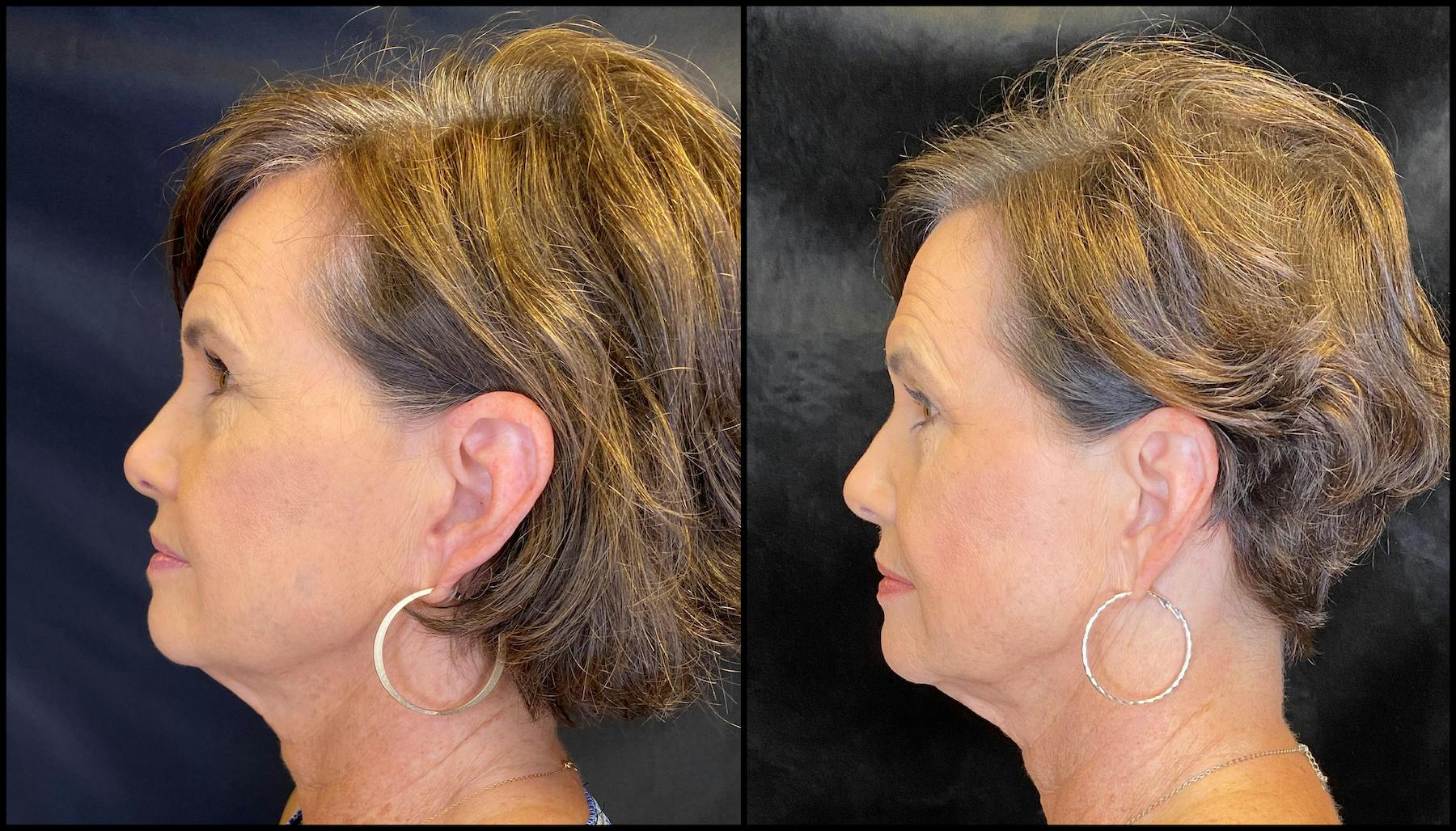 AccuTite & FaceTite Before & After Gallery - Patient 63591875 - Image 3