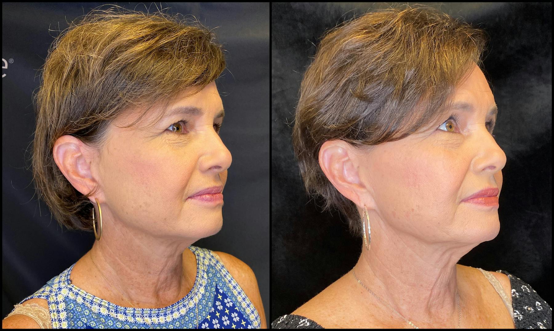 AccuTite & FaceTite Before & After Gallery - Patient 63591875 - Image 4