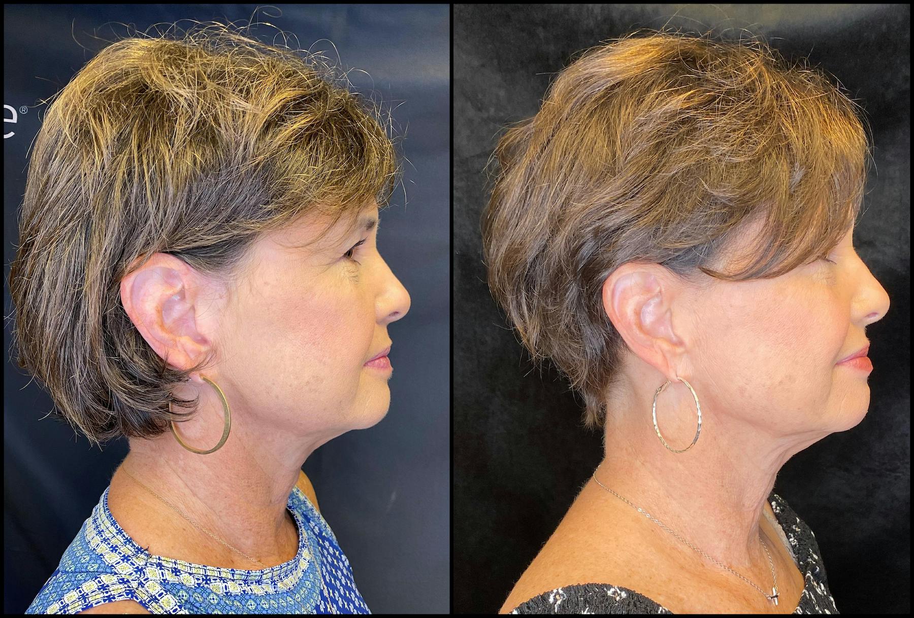AccuTite & FaceTite Before & After Gallery - Patient 63591875 - Image 5
