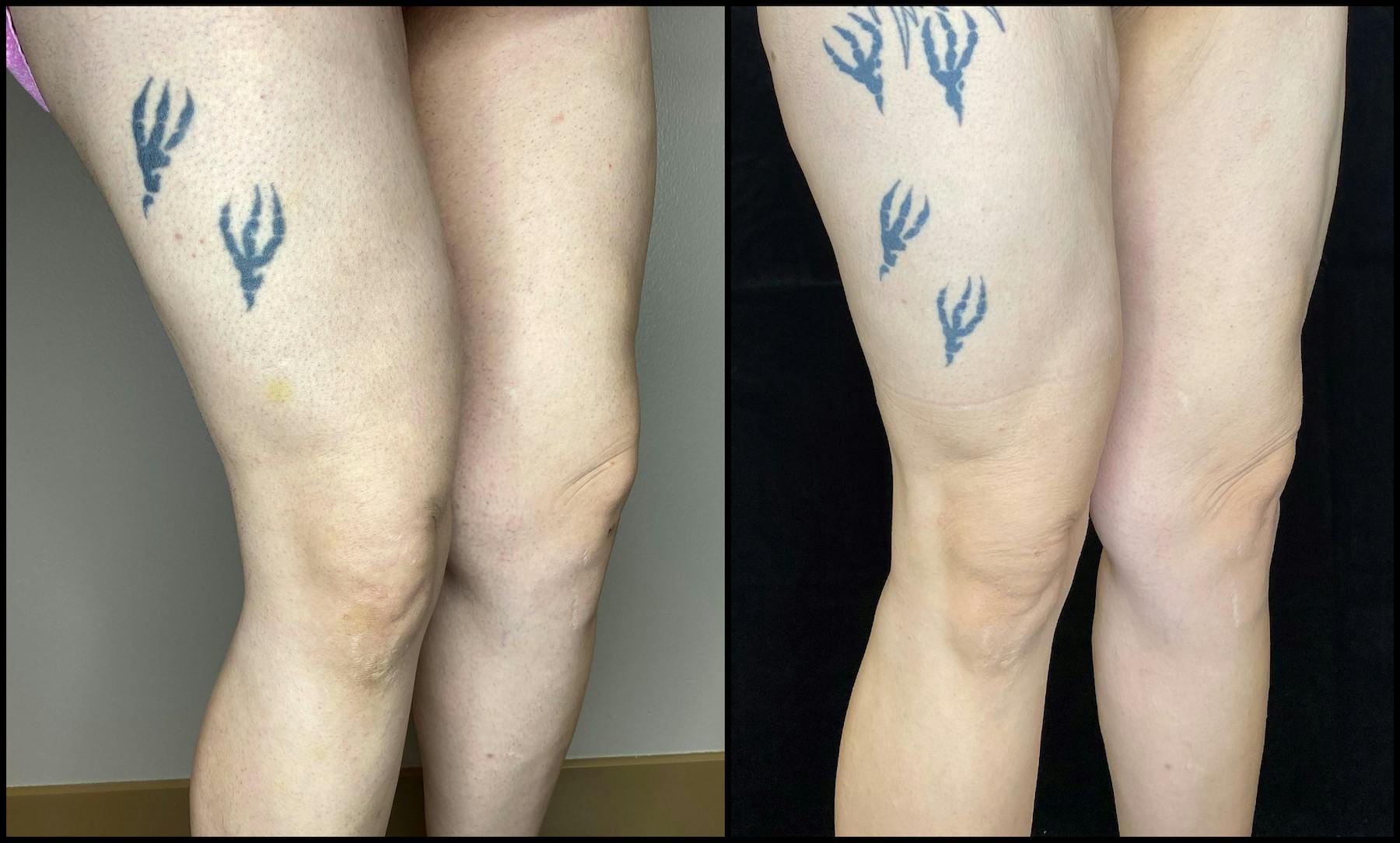 AccuTite Before & After Gallery - Patient 64674949 - Image 1