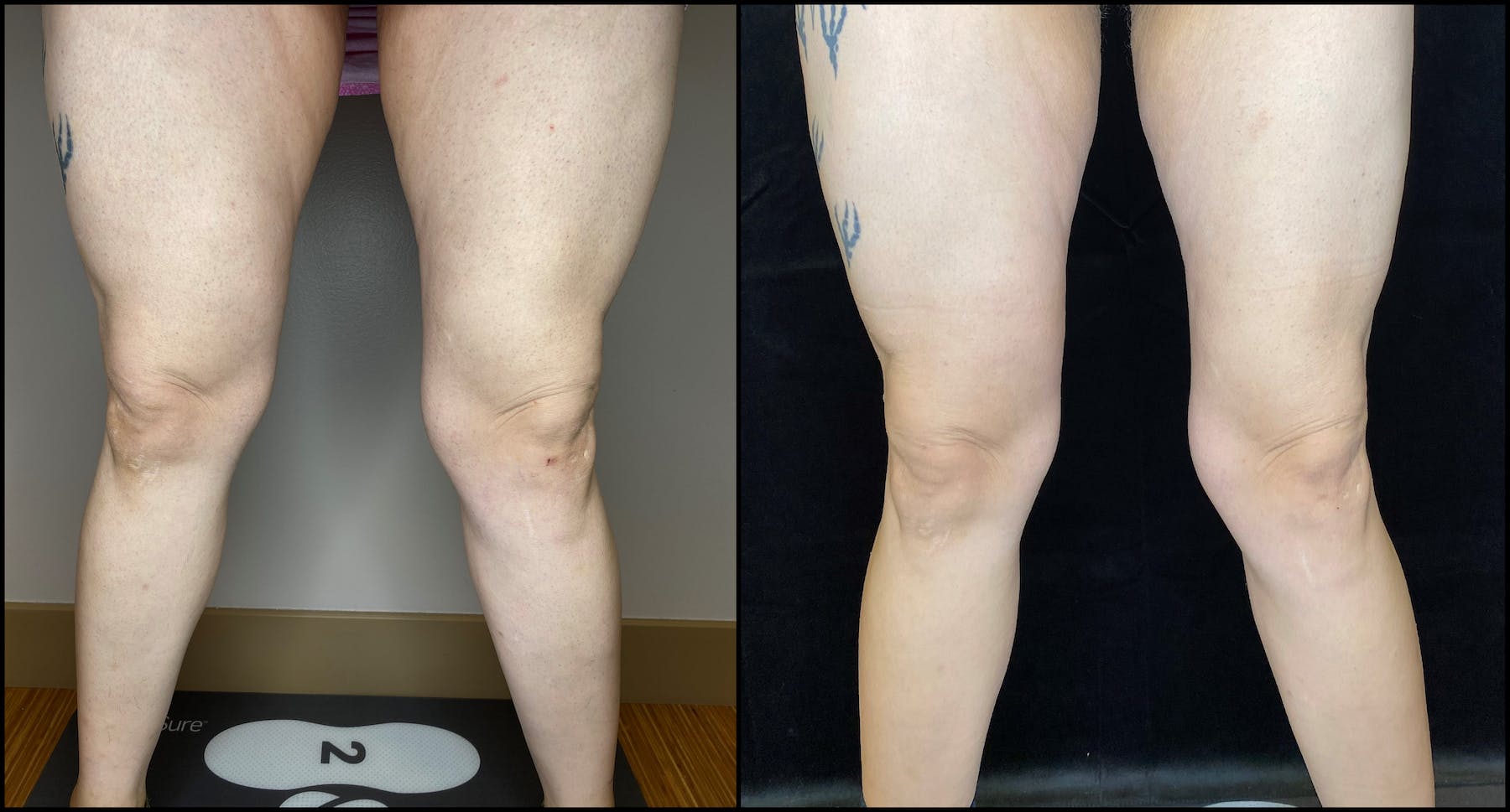 AccuTite Before & After Gallery - Patient 64674949 - Image 3