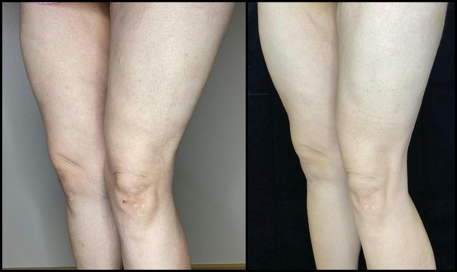 AccuTite Before & After Gallery - Patient 64674949 - Image 2