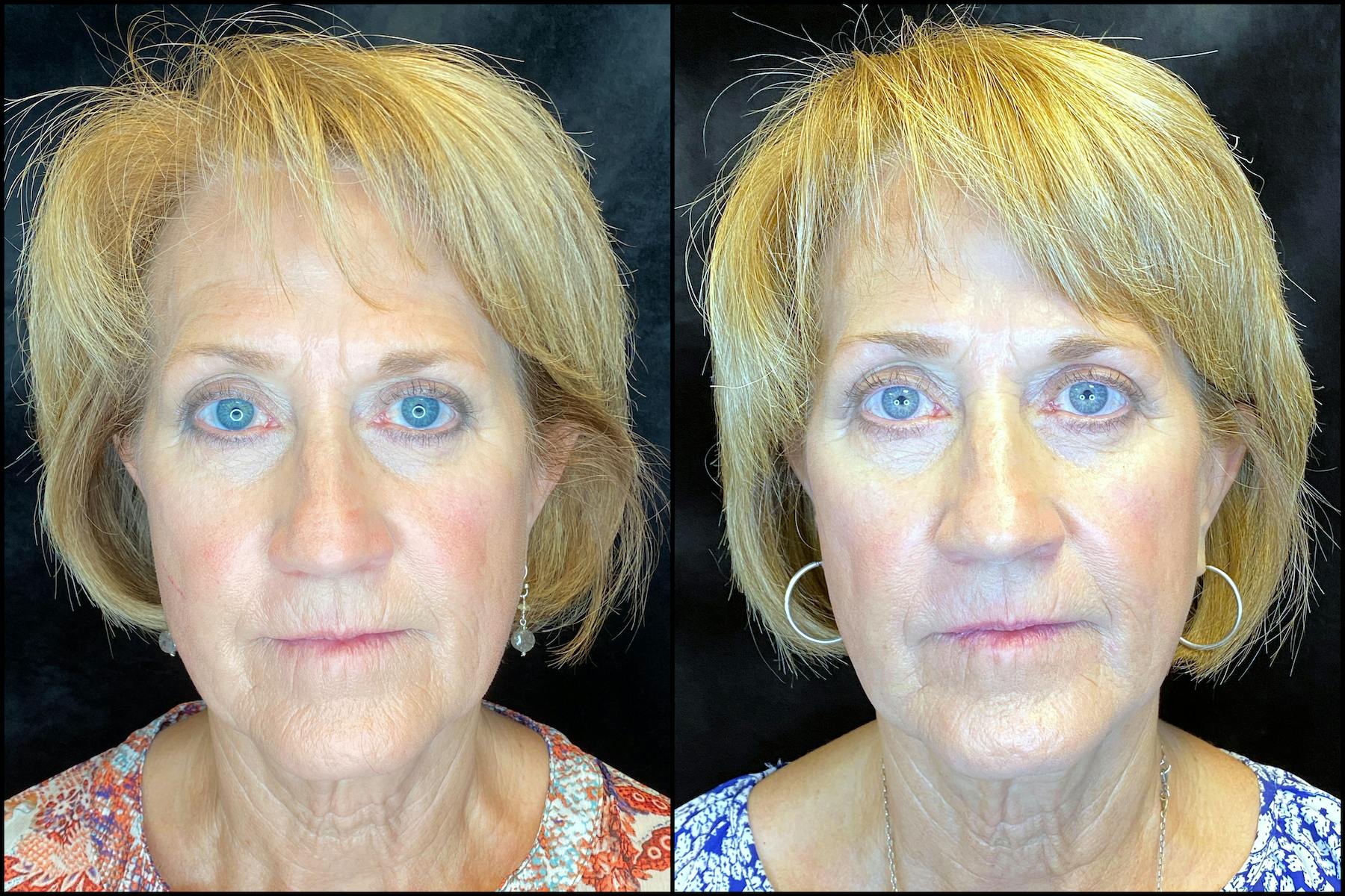 Patient 63591888, AccuTite & FaceTite Before & After Photos