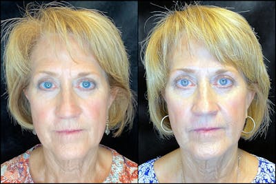 AccuTite & FaceTite Before & After Gallery - Patient 63591888 - Image 1