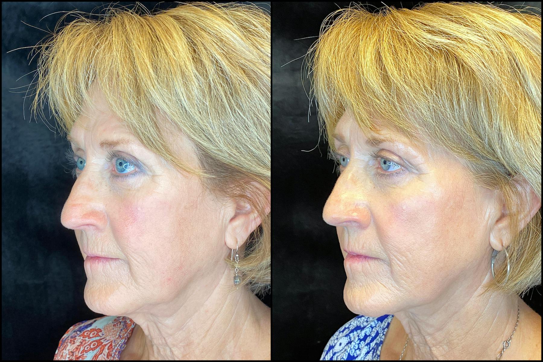 AccuTite & FaceTite Before & After Gallery - Patient 63591888 - Image 2