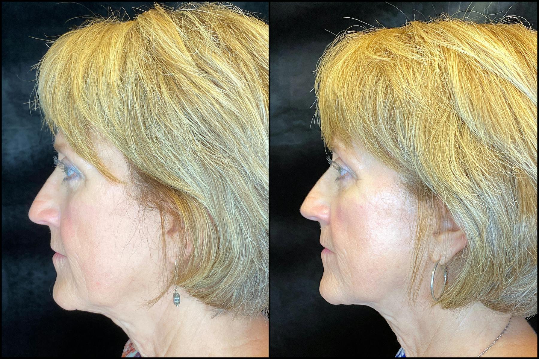 AccuTite & FaceTite Before & After Gallery - Patient 63591888 - Image 3