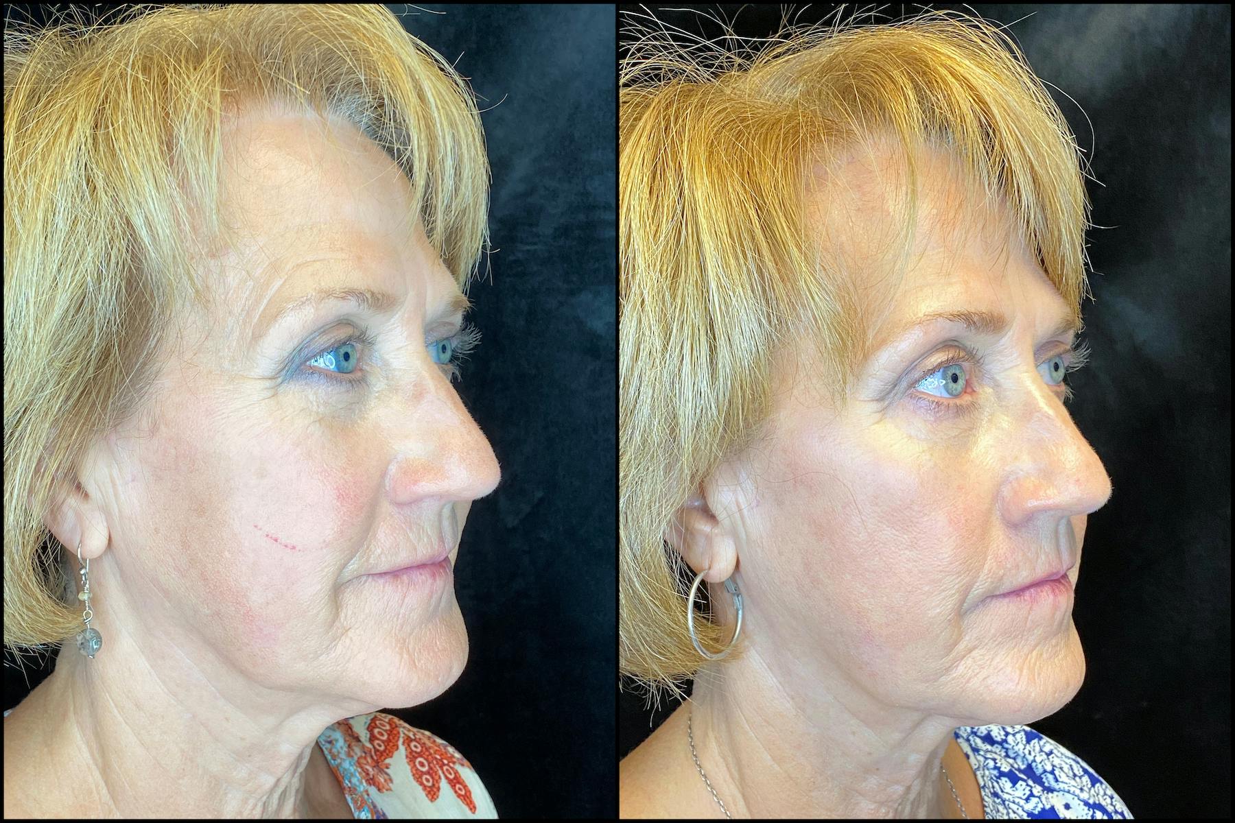 AccuTite & FaceTite Before & After Gallery - Patient 63591888 - Image 4