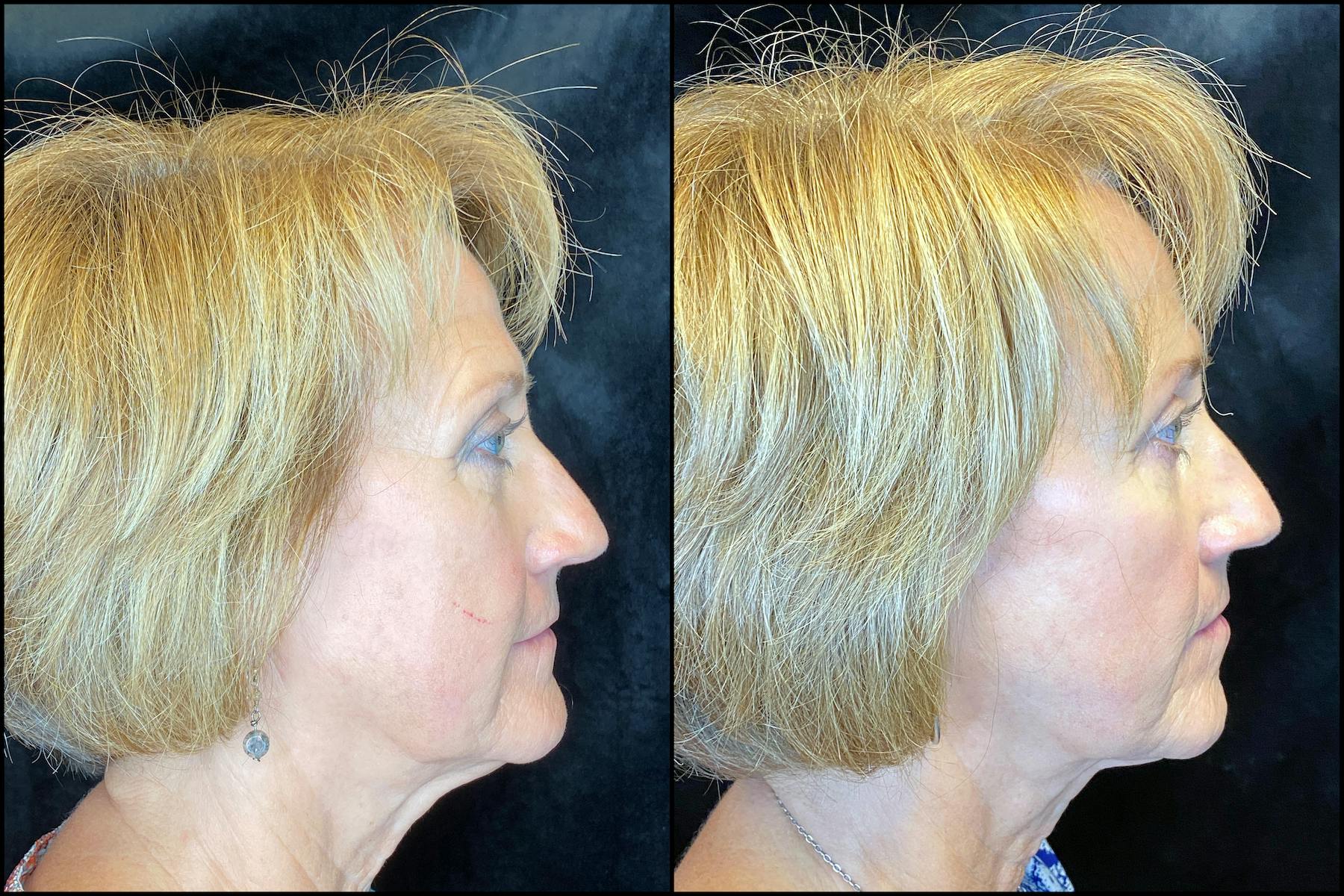 AccuTite & FaceTite Before & After Gallery - Patient 63591888 - Image 5