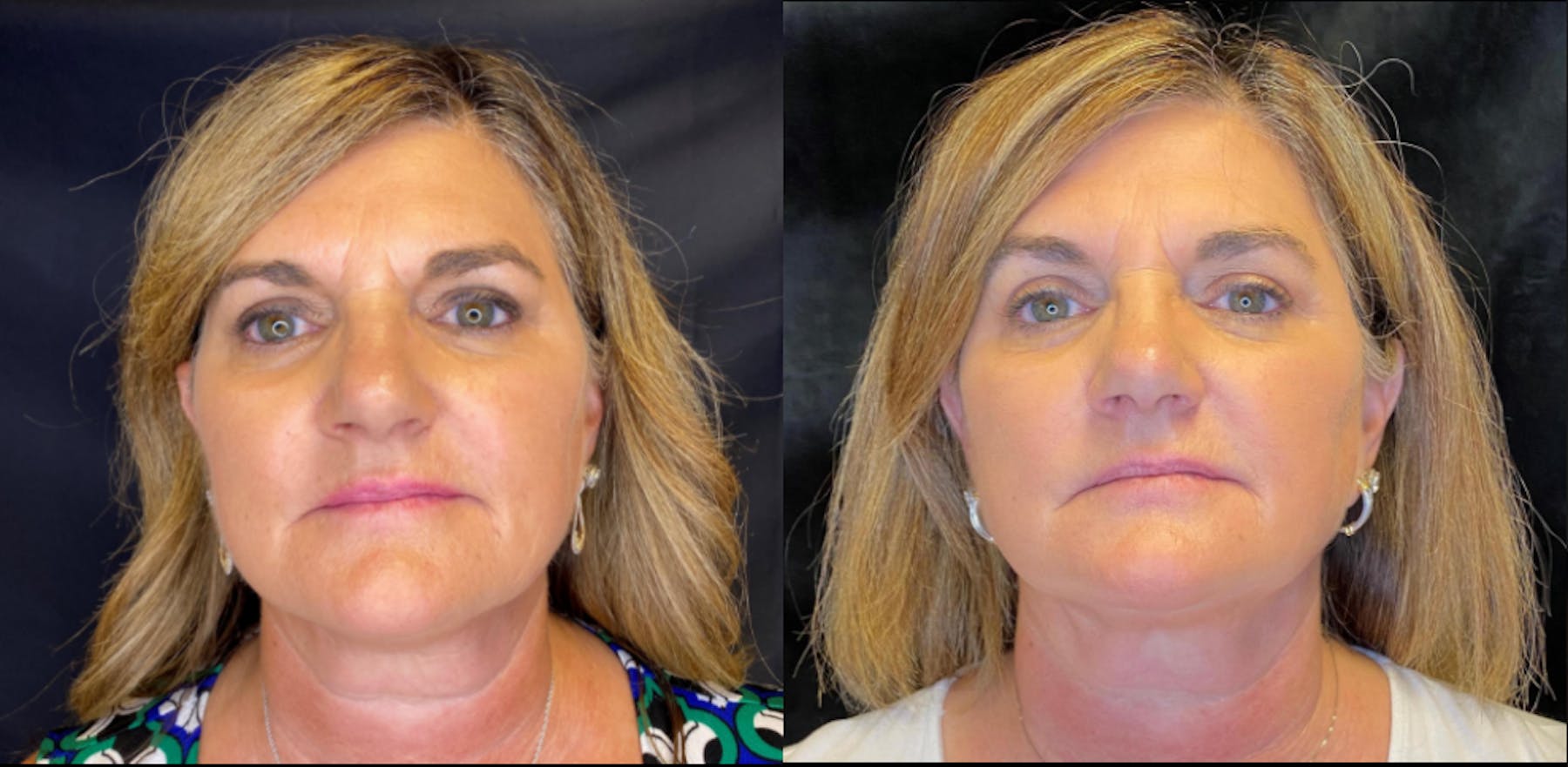 AccuTite & FaceTite Before & After Gallery - Patient 63591892 - Image 1