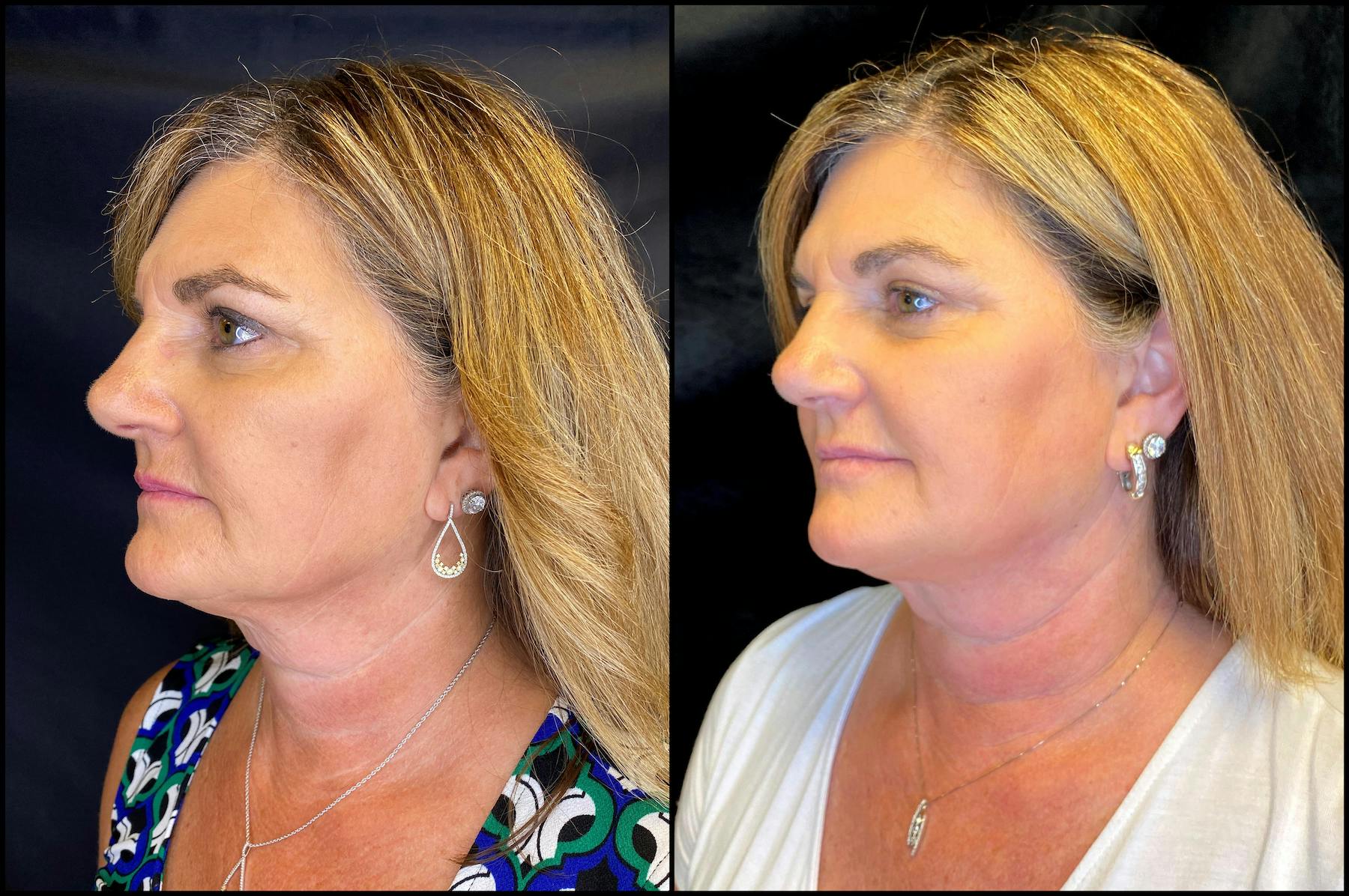 AccuTite & FaceTite Before & After Gallery - Patient 63591892 - Image 2