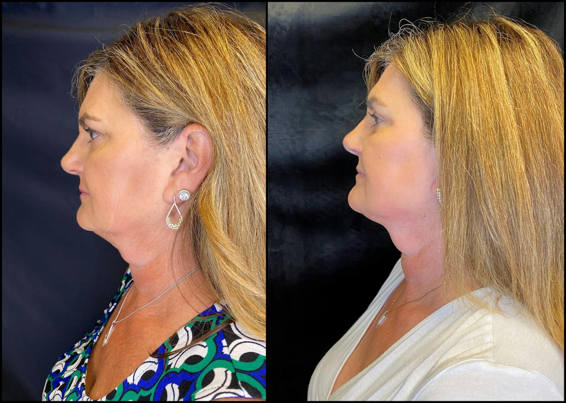 AccuTite & FaceTite Before & After Gallery - Patient 63591892 - Image 3