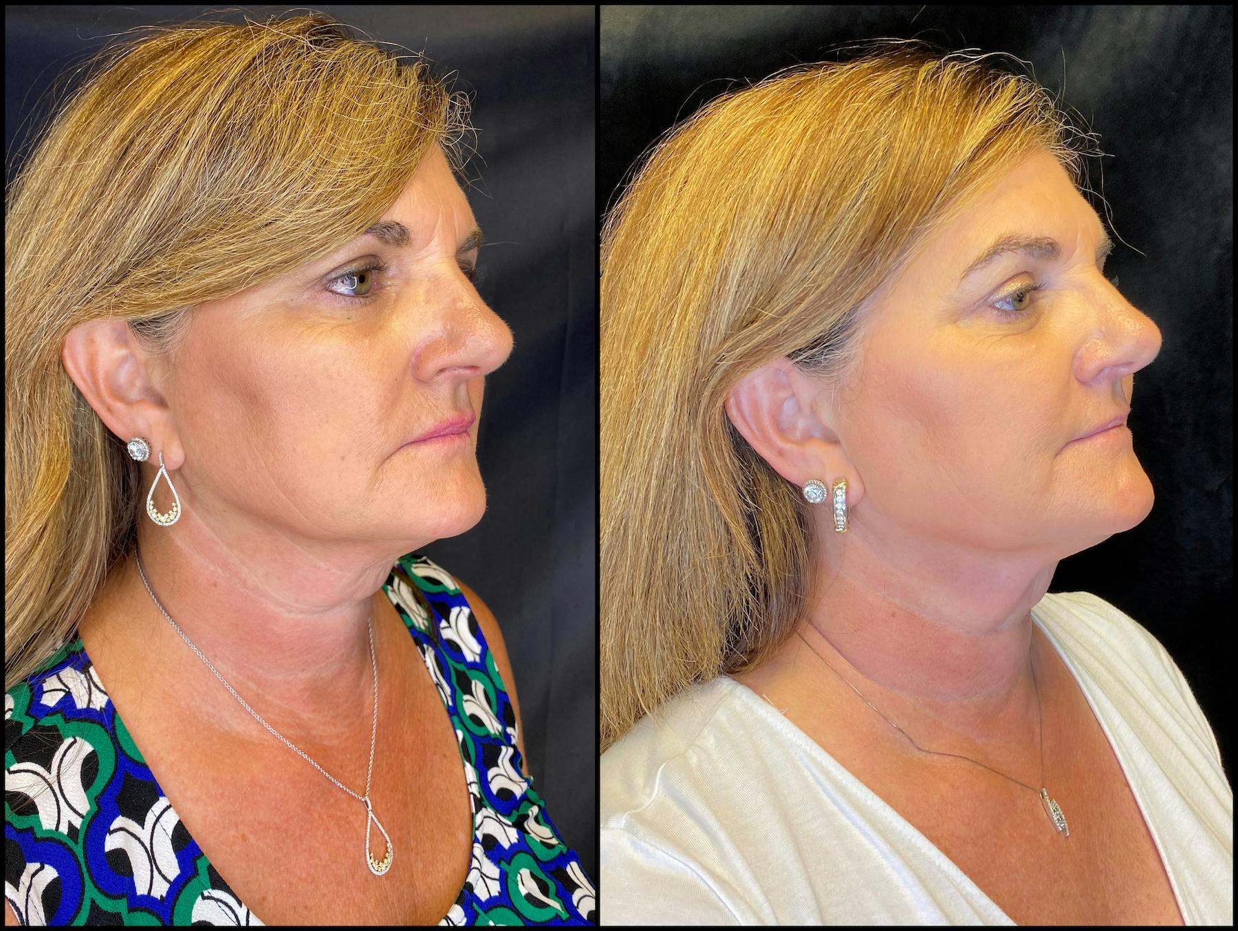 AccuTite & FaceTite Before & After Gallery - Patient 63591892 - Image 4