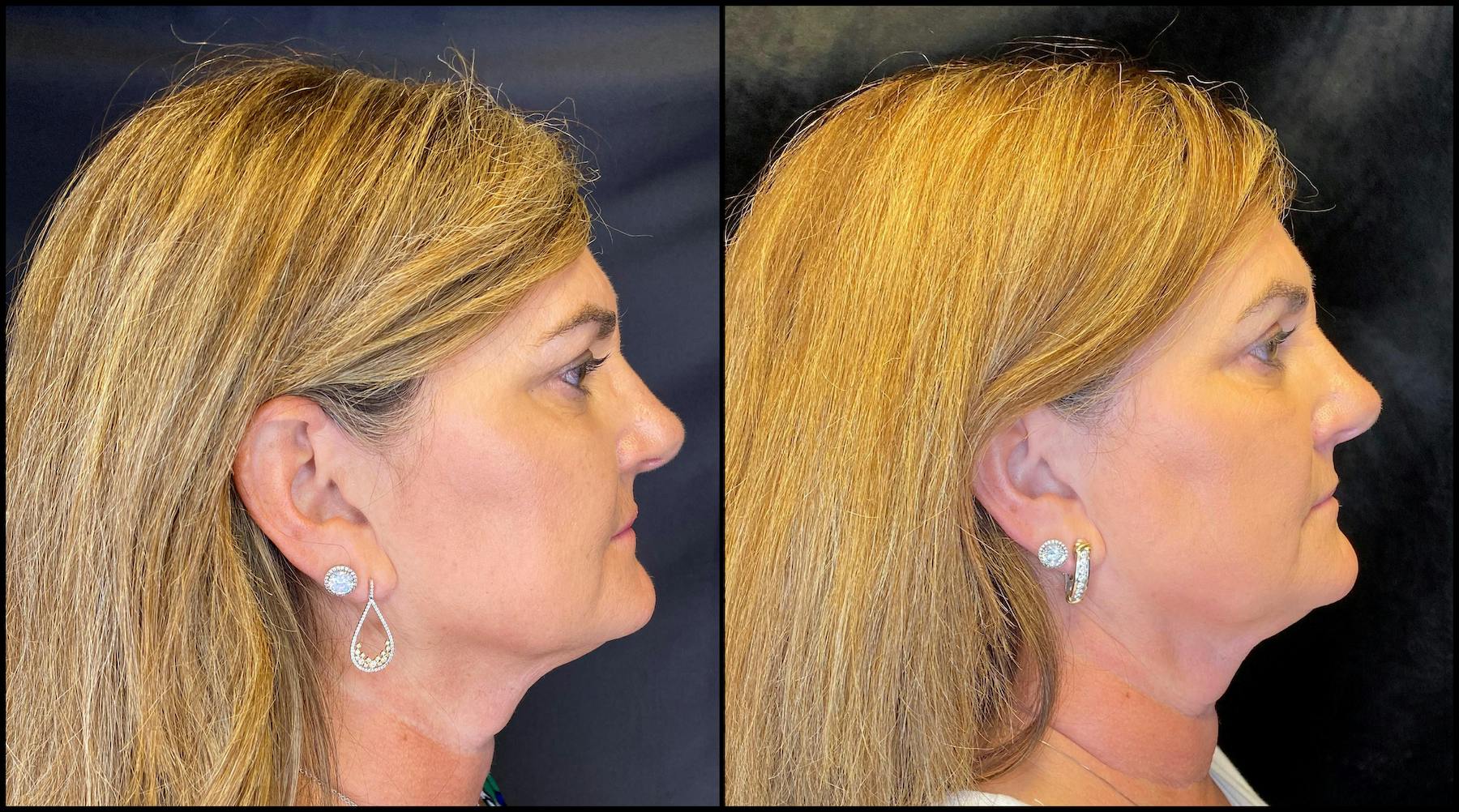 AccuTite & FaceTite Before & After Gallery - Patient 63591892 - Image 5