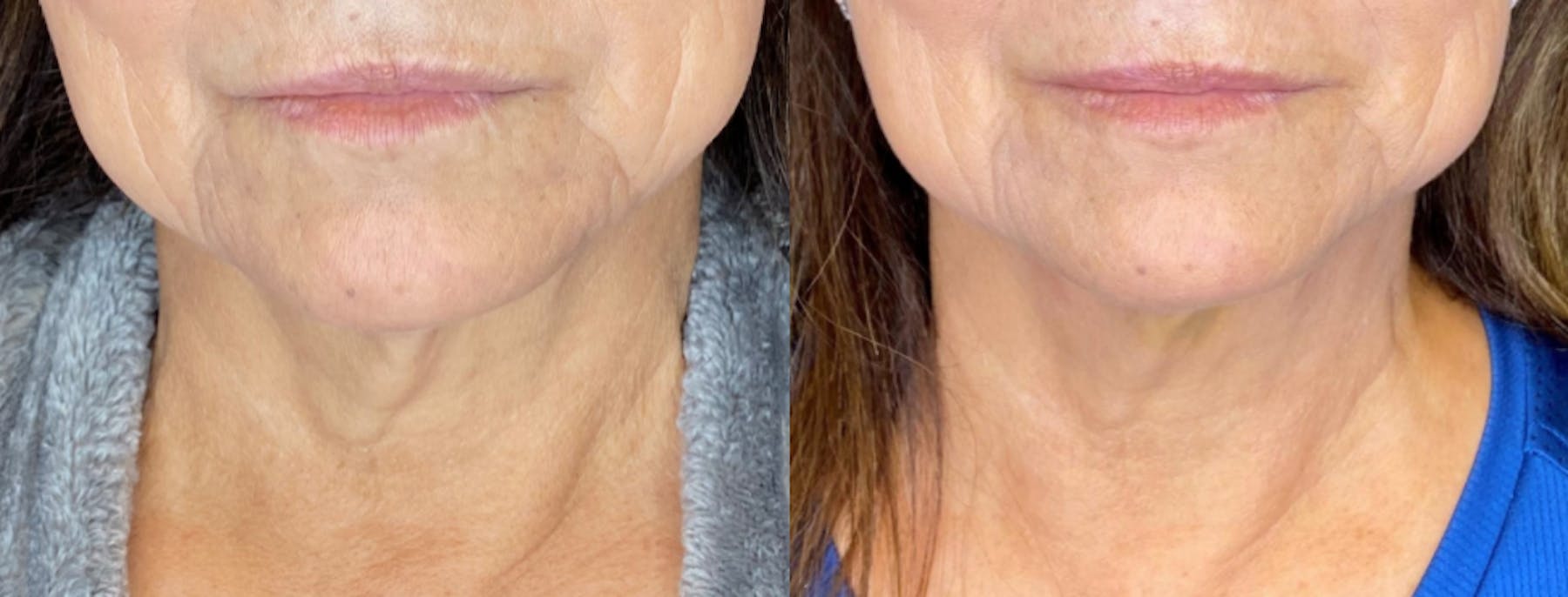 AccuTite & FaceTite Before & After Gallery - Patient 63591894 - Image 1