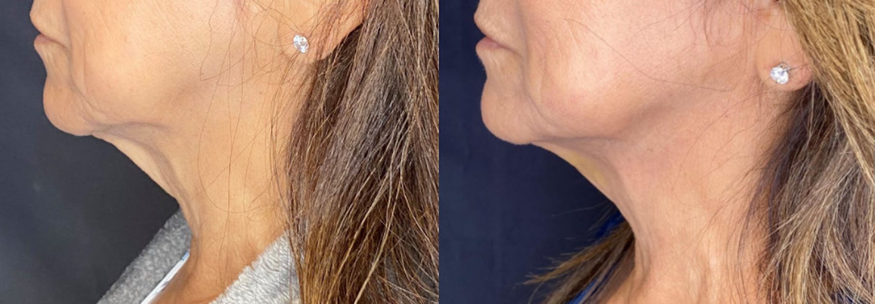AccuTite & FaceTite Before & After Gallery - Patient 63591894 - Image 3