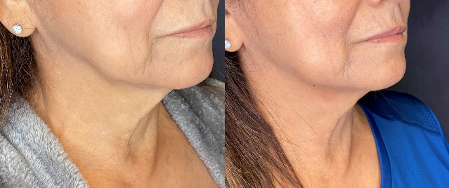 AccuTite & FaceTite Before & After Gallery - Patient 63591894 - Image 4