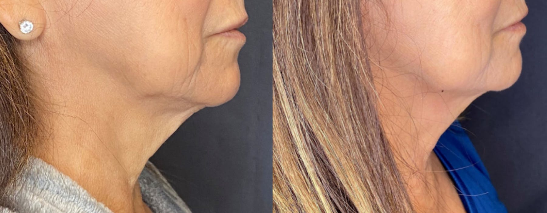 AccuTite & FaceTite Before & After Gallery - Patient 63591894 - Image 5