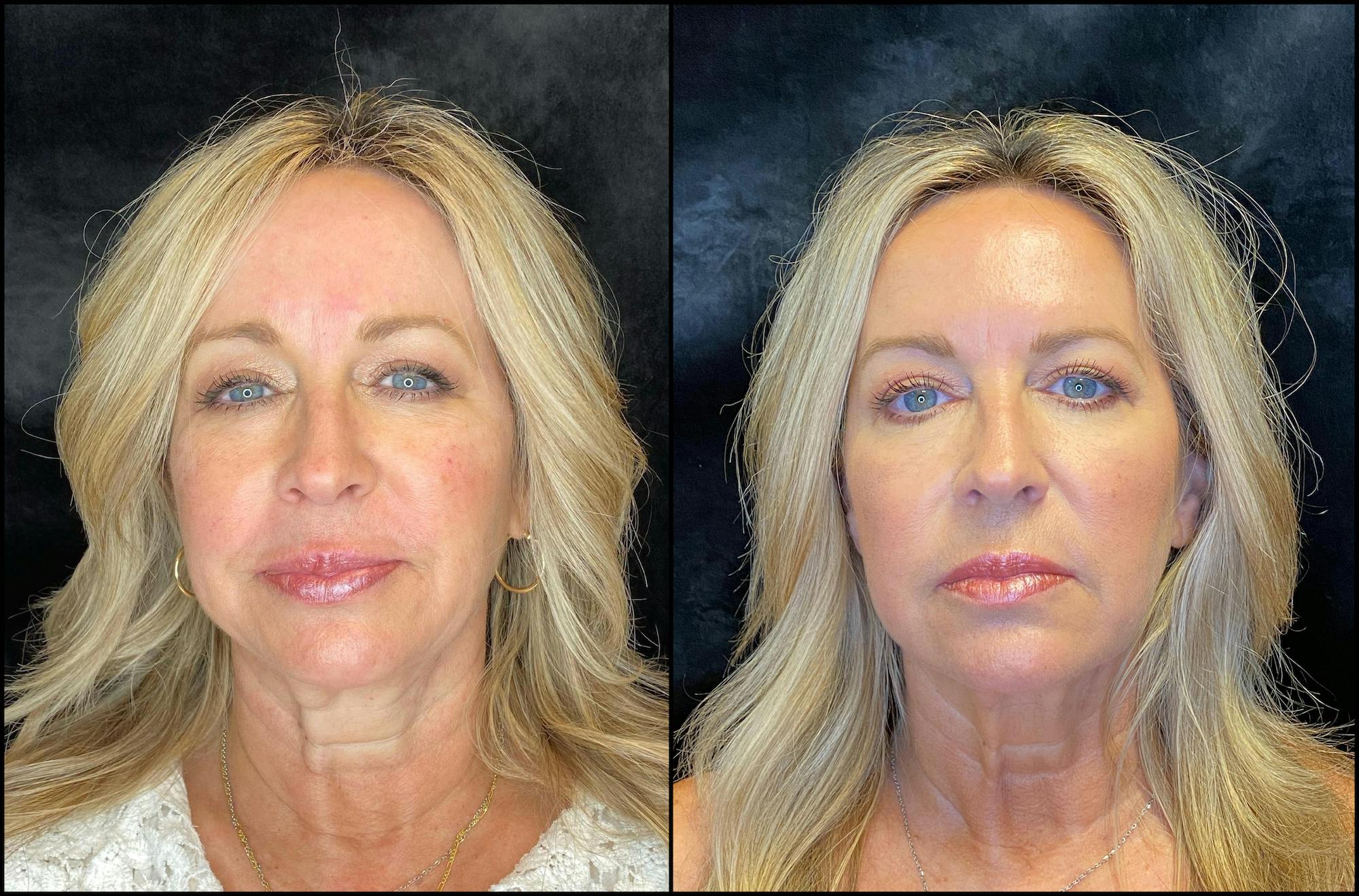 Before and after Evoke in Bee Cave at Modern Women's Health