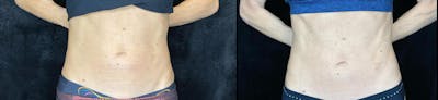 Evolve Before & After Gallery - Patient 63591985 - Image 1